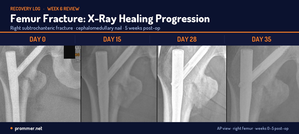 Four AP X-rays of a right subtrochanteric femur fracture fixed with a cephalomedullary nail, showing healing from Day 0 to Day 35 as bridging callus fills in across the fracture line