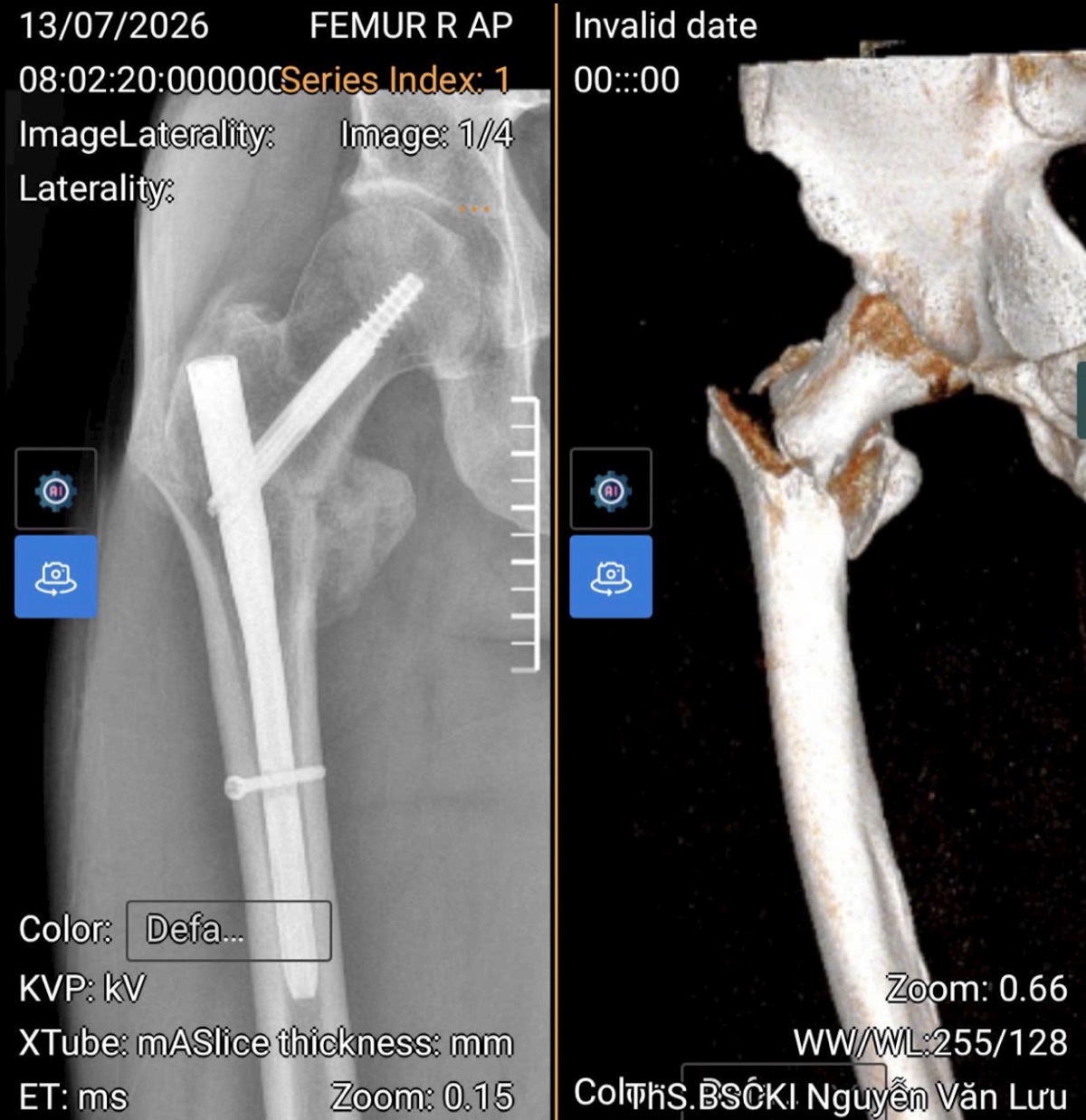 Week 12 right femur AP X-ray (July 13, 2026) beside a 3D CT reconstruction, showing the cephalomedullary nail and lag screw in place with the subtrochanteric fracture healing on schedule